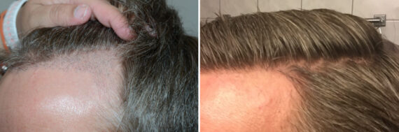 Hair Transplants for Men Before and after in Miami, FL, Paciente 59194