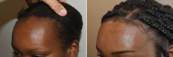 Forehead Reduction Surgery Before and after in Miami, FL, Paciente 126852