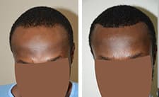 Cirugía única de reducción de la línea del cabello masculina