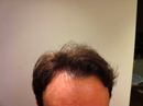Dr. Epstein Hair Transplant Patient - NYC