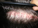 Dr. Epstein Hair Transplant Patient | NY